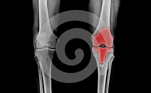 TKA knee joint x-ray