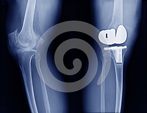 Hight quality x-ray with knee joint replacement photo
