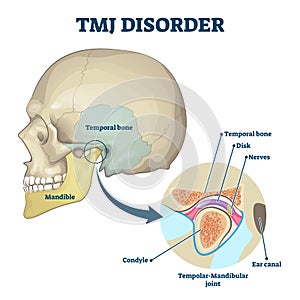 TMJ disorder vector illustration. Labeled jaw condition educational scheme.