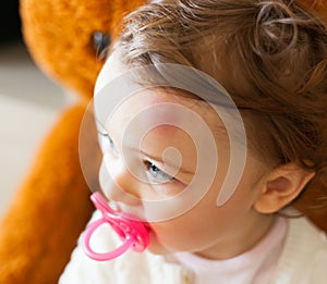 Toddler with big bruise on his forehead after bumping.