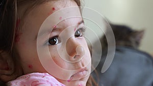 Toddler girl with chickenpox measles on the body. Varicella virus childhood contagious disease. Itchy red blisters
