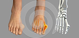 Toe deformation, also known as hallux valgus, or bunion