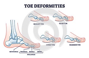 Toe deformities and medical foot phalanges bone defects outline diagram