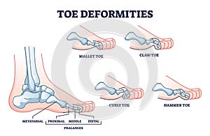 Toe deformities and medical foot phalanges bone defects outline diagram photo
