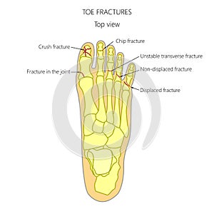 Toe fractures