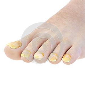 Toe nail fungus