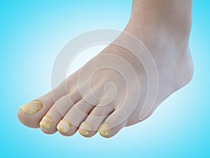 Toe nail fungus