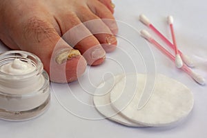 Toenail affected by a fungus with cream in a jar, cotton pads and cotton buds.