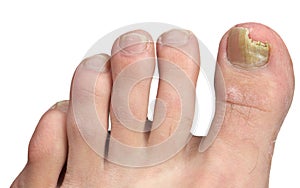 Toenail Fungus at Peak Infection photo