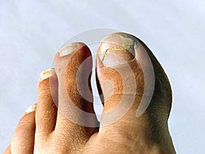 A toenail fungus at the peak of the infection. Painful toe contagious with onychomycosis. Active phase of the disease. untreated