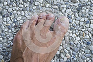 Toenails with fungus problems on gray stone background