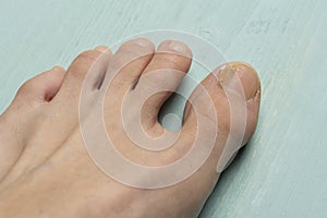 Toenails with fungus problems on green table close up