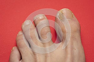 Toenails with fungus problems on red table