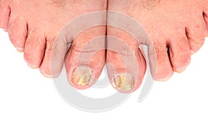 Toenails infected with fungus