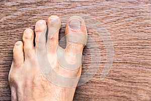 Toes affected by dermal problems, red rash produced plaques of psoriasis