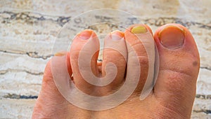Toes in close up with a fungus infected nail, Common infection and disease
