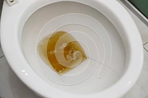 Toilet bowl containing dark urine photo