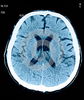 Tomography of the brain.