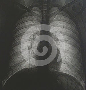 Tomography of human chest no pathologies