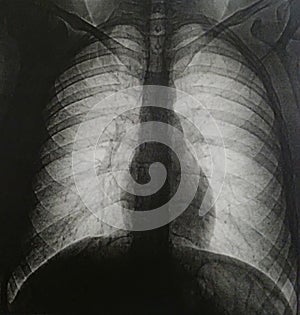 Tomography of human chest no pathologies