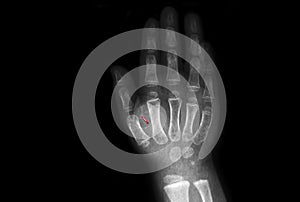 Tomography that illustrated people implant chips in their hands. A small microcircuit is placed between the thumb and forefinger.