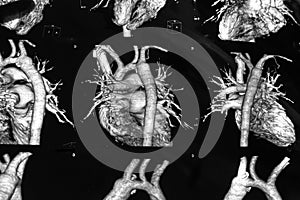 Tomography image of the heart
