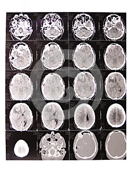 Tomography x-ray