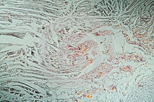 Tongue with amyloid deposits of sick tissue