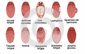 Tongue diseases illustration