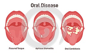 Tongue problems set. Fissured tongue, oral candidiasis and aphthous