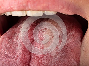 tongue with stomatitis close up, oral cancer photo