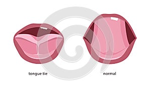 Tongue tie of a baby before and after surgery