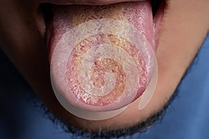 tongue with ulcers of adult man.Cracks in the tongue of a young man.man with halitosis for candida albicans on tongue.