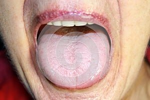 The tongue is in a white raid. Candidiasis in the tongue photo