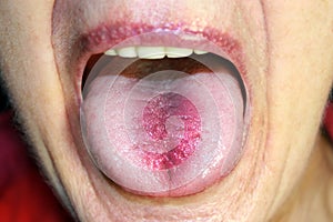 The tongue is in a white raid. Candidiasis in the tongue photo