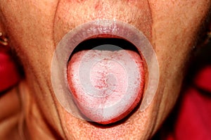 The tongue is in a white raid. Candidiasis in the tongue photo