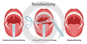 Tonsillectomy. Acute pharyngitis treatment, surgical removal of the tonsils,