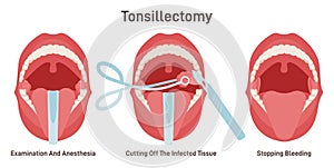 Tonsillectomy. Acute pharyngitis treatment, surgical removal of the tonsils, photo