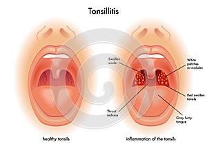 Tonsillitis photo