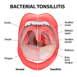 Tonsillitis bacterial