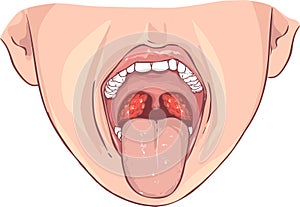 Tonsillitis bacterial