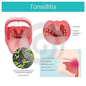 Tonsillitis. Inflammation of the soft tissue in the mouth and pain in swallowing occurs. Illustration.