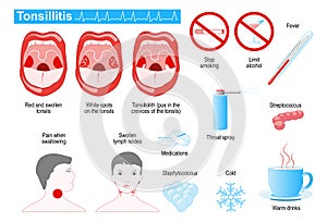 Tonsillitis infographic photo