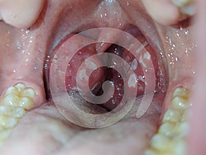 Tonsils. Angina. Tonsillitis. Bacterial disease produced in the tonsils that causes swelling and plaque. Bad mouth.