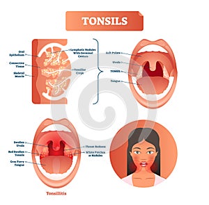 Tonsils vector illustration. Tonsillitis labeled structure diagram.