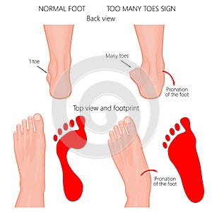 Too many toes