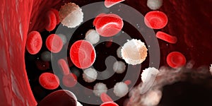 too many white blood cells due to leukemia