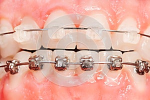 Tooth alignments with ceramic and metal braces photo