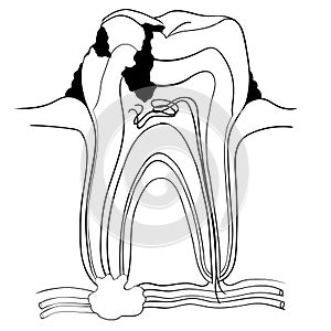 Tooth broke and caries anatomy, medical concept-Vector Illustra