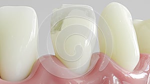 Tooth with caries attack in closeup - 3D Rendering